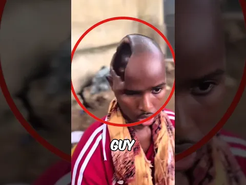 This Guy Lives Without a Brain😲