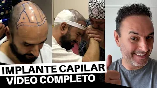 TUDO SOBRE O IMPLANTE CAPILAR DO MAIKEL POR ALICE SALAZAR