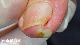 DEDO ENCRAVADO #podologomaurelio #podiatry #satisfying