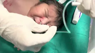 Nasogastric tube (NG) insertion in a neonate | newborn | orogastric tube | feeding tube