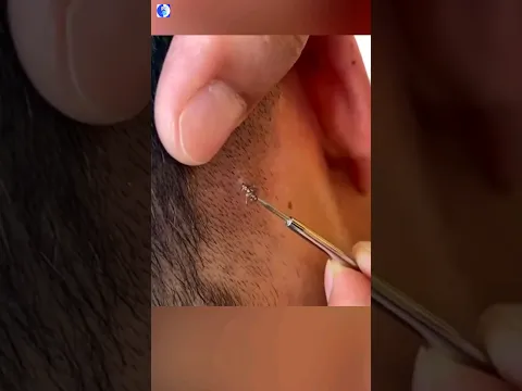 What Is Ingrown Hair #shorts