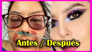CIRUGIA PLASTICA en CARA, BLEFAROPLASTIA, PEXIA DE CEJAS, TRANSFERENCIA DE GRASA, BICHECTOMIA