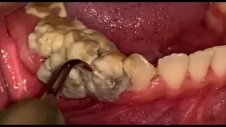 The doctor treated the teeth professionally​​ #6393