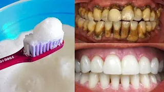 3 cách làm trắng răng bị ố vàng sau 1 đêm, răng xỉn màu ố vàng mấy cũng trắng bóc