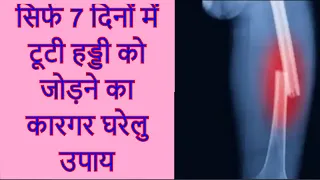 सिर्फ 7 दिनों में टूटी हड्डी को जोड़ने का कारगर घरेलु उपाय | Fracture Bones Treatment