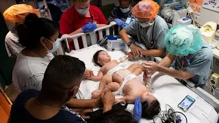 Parents pray before conjoined twin sons separated at Texas Children's in Houston