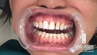 Unilaser | Paso a paso Diseño de Sonrisa en Resina de Alta Estética