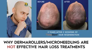 Why Dermarollers/Microneedling for Hair Loss have Minimal Results