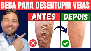 5 BEBIDAS INCRÍVEIS para COMBATER MÁ CIRCULAÇÃO, VARIZES e DOR nas PERNAS