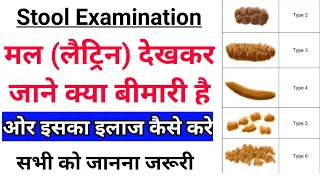 मल (लेट्रिन) को देखकर बीमारी के बारे मे जाने - Stool examination || सभी को पता होना चाहिए