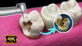 Reparacion dientes con caries : Endodoncia en 4K / Muela rota