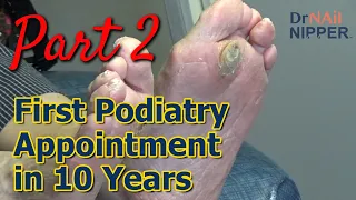 Monster Callus - First Podiatry Appointment in 10 Years, Part 2.  Callus Tuesday (2023)