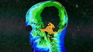 A Boy Ate 180 Gummy Melatonins For Lunch. This Is What Happened To His Brain.