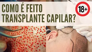 COMO É FEITO O TRANSPLANTE CAPILAR | TUDO O QUE VOCÊ PRECISA SABER!