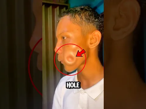 OMG😱 HOLE ON CHEEK‼️