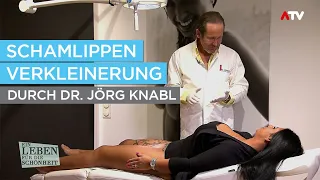 Schamlippen-Verkleinerung und Wangen-Verschmälerung - gemacht durch Dr. Jörg Knabl
