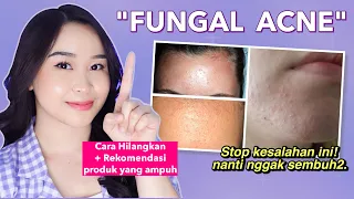 8 Cara Menghilangkan Jerawat Kecil-Kecil di Wajah ("Fungal Acne")