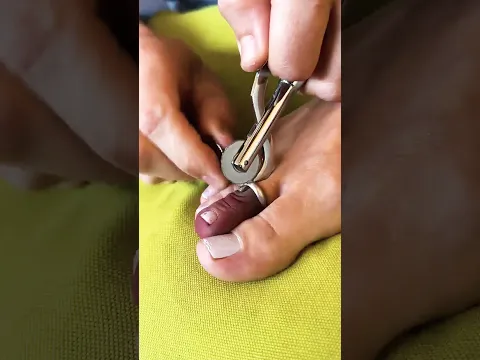 Genius Hack to Remove a Stuck Ring!