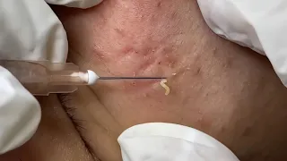 Deep Blackheads Removal from Cheeks and Nose | Best Pimple Popping Video #004 