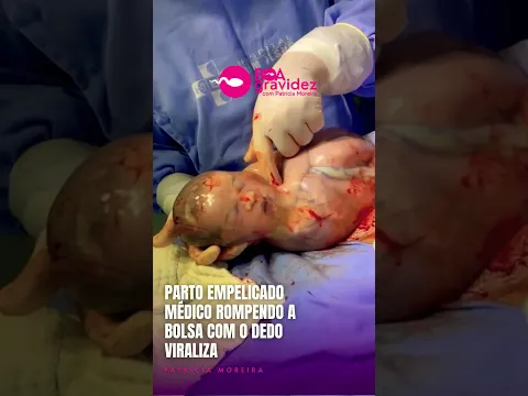 Médico rompe a bolsa amniótica do bebê com o dedo - Parto Empelicado