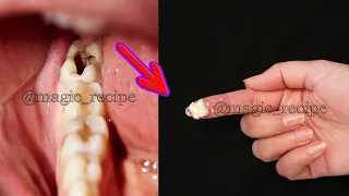 أقسم بالله لن تلجأ لإقتلاع الأضراس المسوسة بعداليوم ستعود كالأول بدون تسوس ولا ثقب علاج تسوس الأسنان