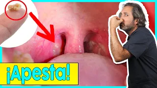 🚫¡EVITA los 𝗧𝗢𝗡𝗦𝗜𝗟𝗢𝗟𝗜𝗧𝗢𝗦! Como quitar esas 𝗔𝗣𝗘𝗦𝗧𝗢𝗦𝗔𝗦 BOLITAS BLANCAS en la garganta (🤮 MAL ALIENTO)