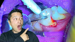 Surgical Tooth Extraction [WARNING] Failed Root Canal