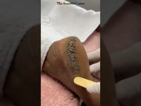 Pedicure extraction foot cleaning