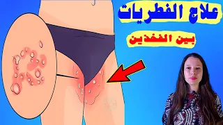 فطريات بين الفخذين : علاج الفطريات بين الفخذين في المنزل