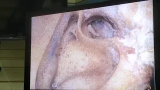 Cochlear Implantation 2 Dr Usama Abdulnaseer