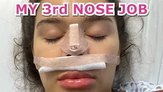 MY 3rd NOSE JOB SURGERY STORY!!👃🏼
