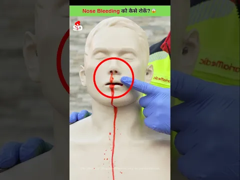 Nose Bleeding को रोकने का तरीका 😱
