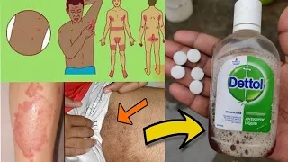 Dettol में ये चीज मिला कर लगा लो सालो पुरानी दाद खाज खुजली दूर हो जाएगी। Ringworm treatment at home