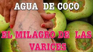 EL MILAGRO DEL AGUA DE COCO CON LAS VARICES