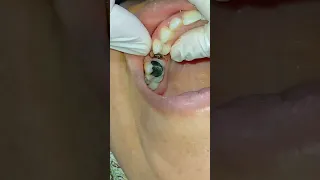خلع جذر علوي في اقل من دقيقة || extraction of remaining root upper 5#extraction#dentist