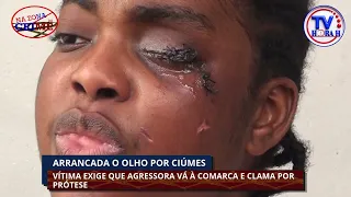 TVHORAH: ARRANCADA O OLHO POR CIÚMES VÍTIMA EXIGE QUE AGRESSORA VÁ À COMARCA E CLAMA POR PRÓTESE