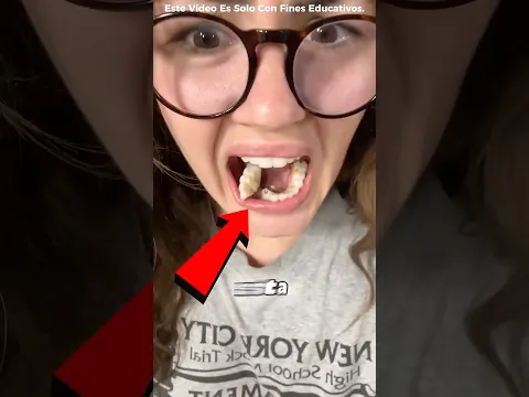 Ella Se Rompió Un Diente 😱