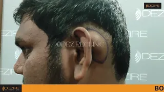 Dermoid Cyst removal #dezireclinic