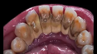 The doctor removed the infection from the tooth