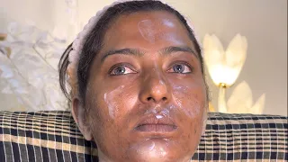 Bridal makeup on acne oily and open pores skin with enhanced  beauty foundation