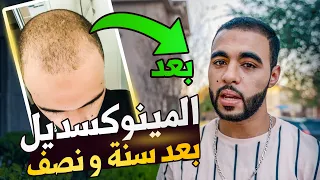 تجربتي مع المينوكسديل بعد سنة ونصف - العلاج الوحيد لتساقط الشعر و إنبات اللحية
