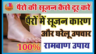 पैरो में सूजन के कारण और घरेलू उपाय व उपचार इस एक उपाय से 100% सूजन एक दिन में होगी पूरी साफ़