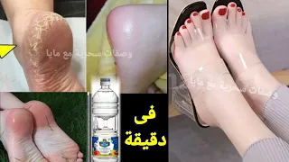 نصف كوب خل وقولي وداعآ لتشققات وخشونه القدمين مجربة مني شخصيآ تقشير . تبييض . ترطيب . بياض كاتلج