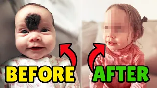 Little Girl Gets Birthmark Removed! 😲 #transformation