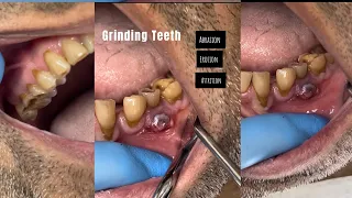 GRINDING TEETH , Abrasion,Erosion ,Attrition
