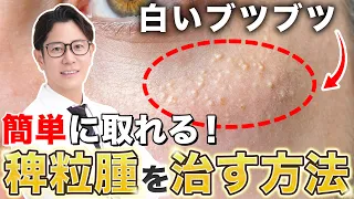 目の周りの白いブツブツ｜稗粒腫を治す方法を解説