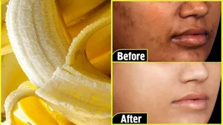 चेहरे के दाग-धब्बें, झुर्रियां, ब्लैकहेड्स और डार्क सर्कल के लिए रामबाण के केले का छिलका| How to use