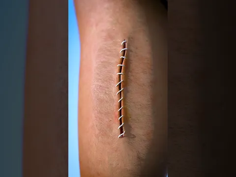 How Stitches Work 😯