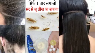 सिर्फ 1 बार लगालो, सर से जू लीख ऐसे गायब होगी जैसे कभी थी ही नहीं Lice and Nits Removal Home Remedy