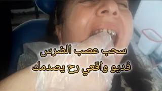 التهاب عصب الضرس | شاهد تفاعل المريض 😳😳| عيادة اسنان